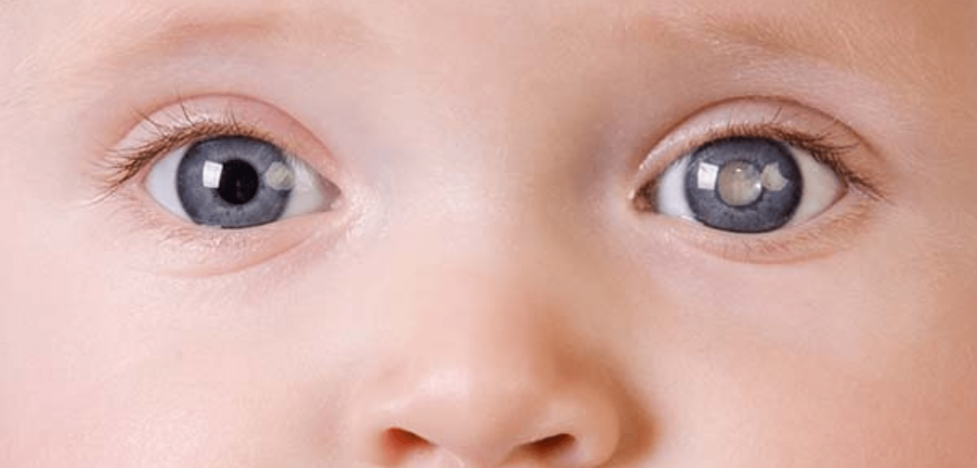 Paediatric Cataract