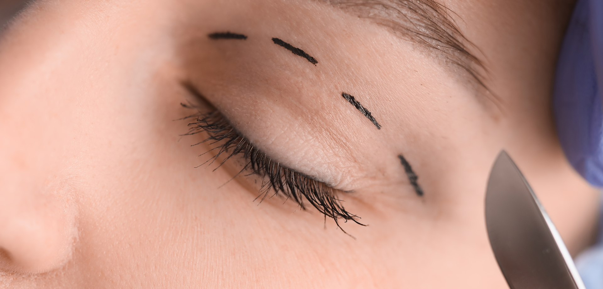 Eyelid Surgery