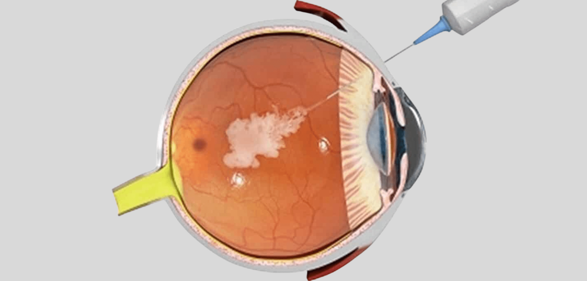 Intravitreal Injections