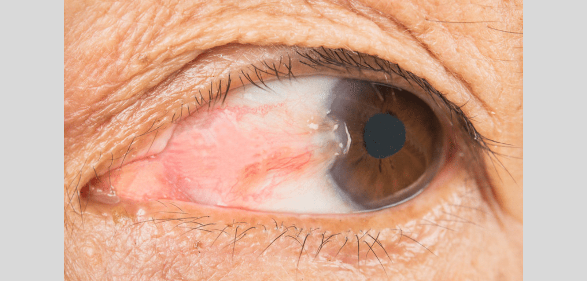 Pterygium Surgery